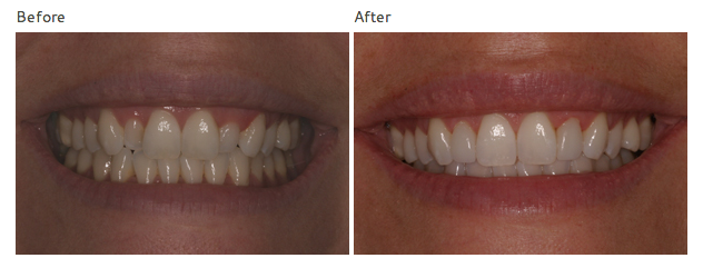 minimal prep veneers