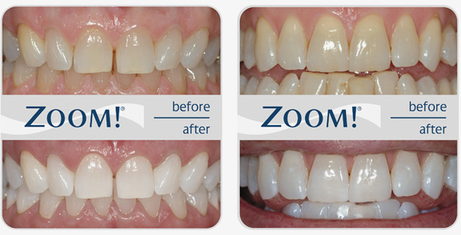 zoom teeth whitening