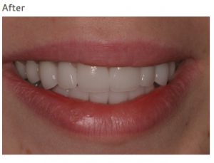 what does full mouth reconstruction mean