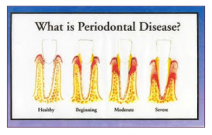 what is gum disease