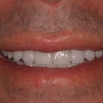 after veneers