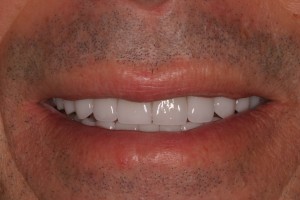 after veneers