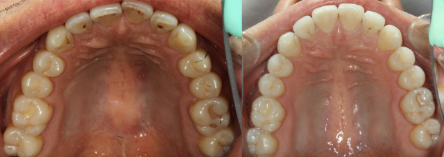 invisalign before after