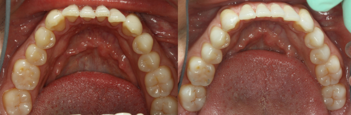 invisalign before after