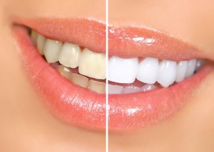 teeth whitening before after