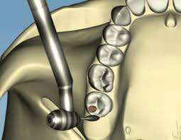 occlusal adjustments