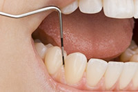 periodontal disease systemic link