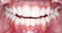 Are Teeth Bones?