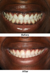 Laser Gum Recontouring Before and After Picture