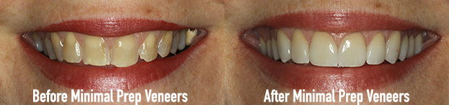 Before and After Minimal Prep Veneers