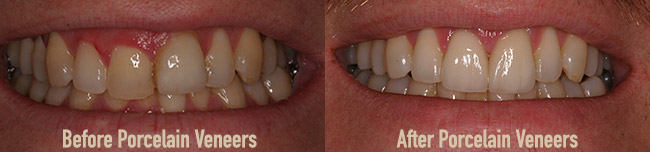 Before and After Porcelain Veneers at Water Tower Dental Care in Chicago