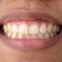 Gingivitis vs. Healthy Gums: What Each Look and Feel Like
