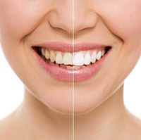 How to Keep Your Teeth White and Unstained After Zoom!