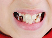 Getting Full-Mouth Reconstruction in Chicago