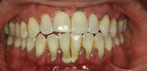 Before Gum Disease Treatment Therapy at Water Tower Dental Care