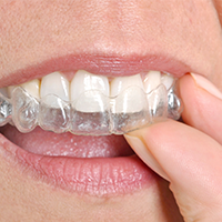 How Invisalign Can Treat Teeth Crowding​