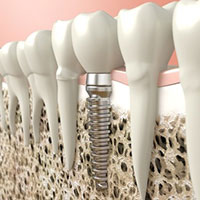 dental implants chicago