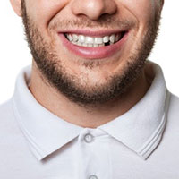tooth loss stress