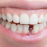 dentures vs dental implants