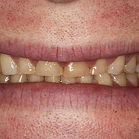 short teeth