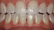 minimal-prep-veneer smile gallery