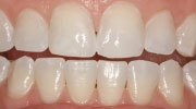 minimal-prep-veneer smile gallery