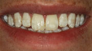 minimal-prep-veneer smile gallery