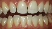 minimal-prep-veneer smile gallery