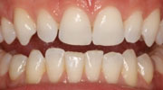 minimal-prep-veneer smile gallery