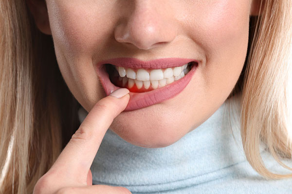 Woman pointing to swollen, bleeding gums, highlighting symptoms of gum disease related to scaling and root planing treatment.