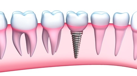 dental implants in Chicago