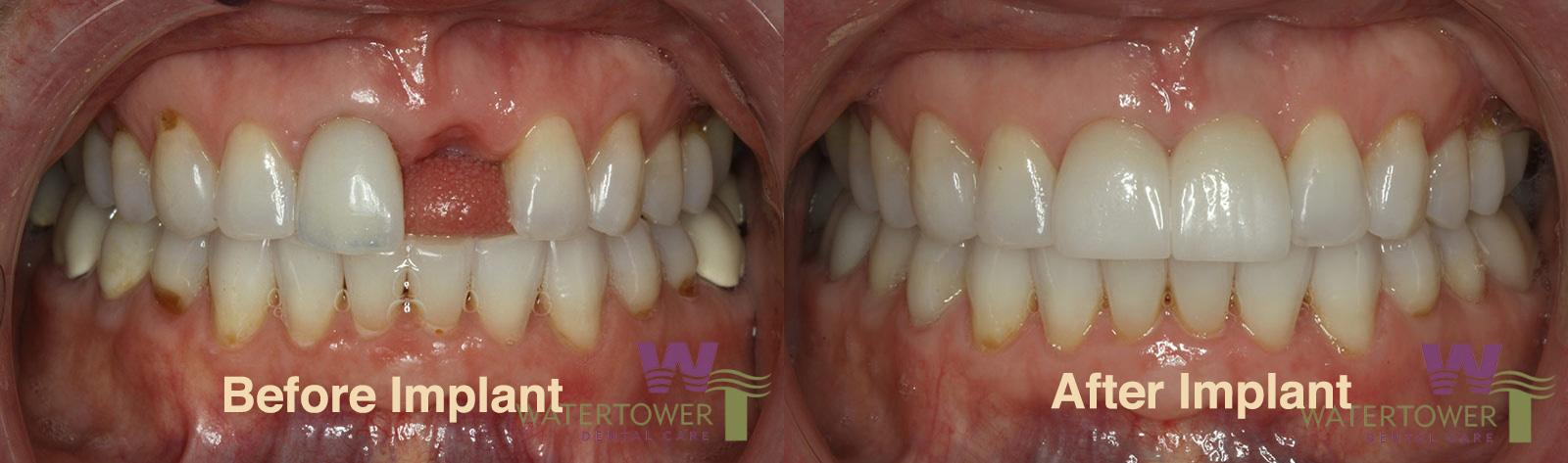 before and after dental implant treatment at Water Tower Dental Care