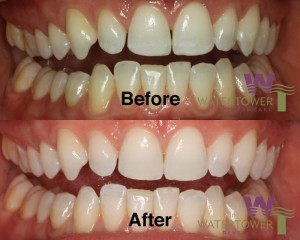 Before and after images of teeth showing enamel remineralization treatment results, illustrating improved whiteness and reduced translucency, with Water Tower Dental Care branding.
