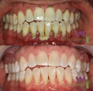 before and after gum disease treatment