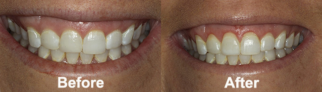 Before and after images of laser gum recontouring treatment, showcasing improved gum line and smile aesthetics.