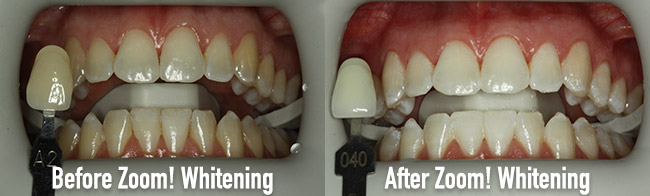 Before and After Zoom! Teeth Whitening at Water Tower Dental Care