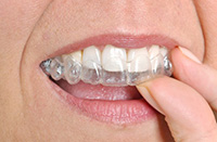 Person inserting Invisalign aligner into mouth, highlighting clear orthodontic treatment for correcting open bite.