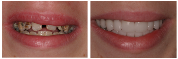 before and after full-mouth reconstruction treatment at Water Tower Dental Care