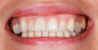 Gum Discoloration: What Causes Gums to Turn Black or White?