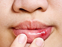 Close-up of a person's lips with a finger pointing at a canker sore, illustrating symptoms for identifying mouth cancer versus canker sores.