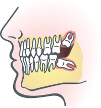Impacted Wisdom Teeth - Wisdom Teeth Removal