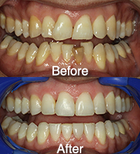 Invisalign Before and After