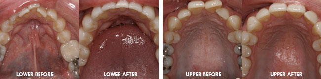 Invisalign for crooked teeth before and after pictures