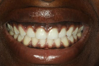 Naturally darker pigment gum tissue