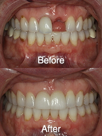 Proccess of a Dental Implant