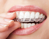 Woman applying teeth whitening tray to her smile, highlighting the use of custom whitening solutions for effective teeth brightening.