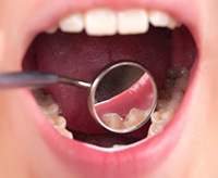 discoloration on teeth