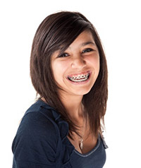 Yellow Teeth After Braces: Why It Happens & How to Fix It