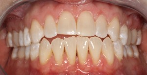 after gum disease treatment