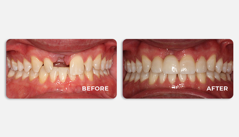 Before and after tooth replacement